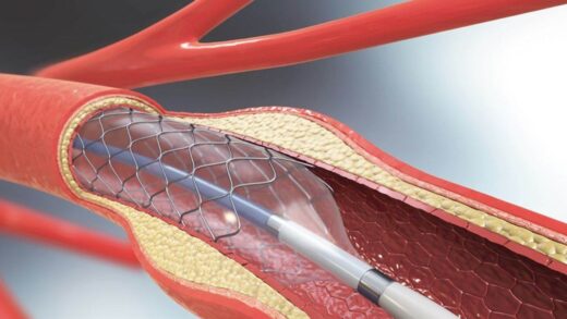 Angioplasty: हार्ट ही नहीं, अब गले और हाथ-पैर की नसों की हो रही एंजियोप्लास्टी, मध्य प्रदेश के एकमात्र सरकारी सुपर स्पेशियलिटी अस्पताल में सुविधा