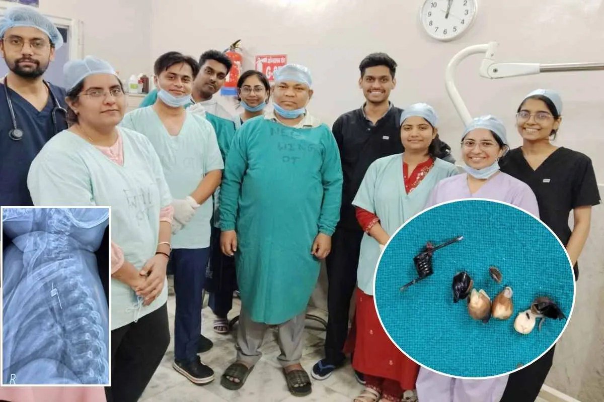 बच्ची के गले में फंसी थी स्प्रिंग, परिजन ने खिला दिए चने, रीवा में डॉक्टर्स ने बचाई जान | Doctors Save One Year Old Girl Spring Stuck In Food Pipe